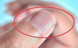 指甲有竖纹，是身体的什么信号？（胃前痣含义）