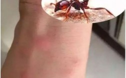 被蚂蚁咬了很痒应该怎么办？
